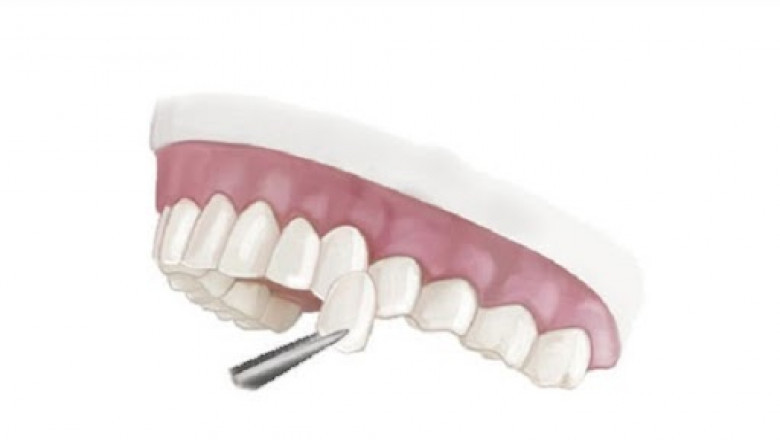 What are the Steps in Veneers Treatment?