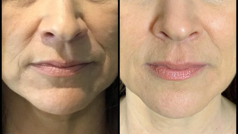 What Impacted COVID-19 on Dermal Fillers ?