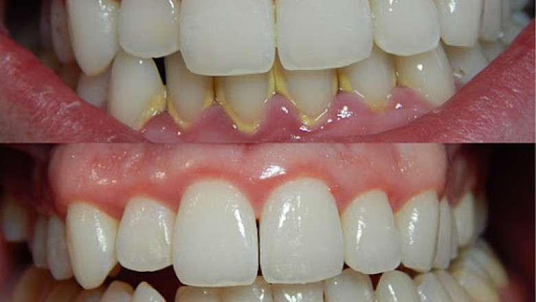 Significant COVID-19 Impact on Periodontitis in the Healthcare Industry