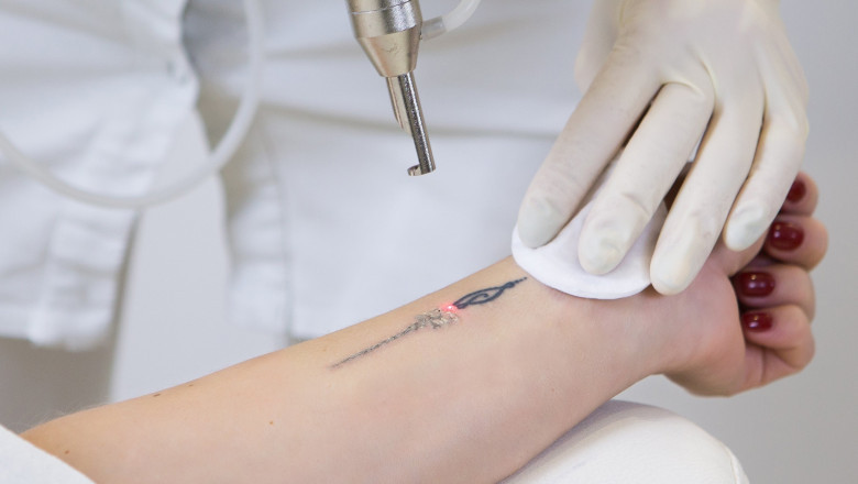 Global Tattoo Removal Market Report Available on Introspective Market Research