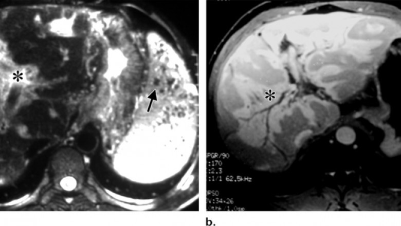 Periportal Fibrosis Market 2021 Future Trend, Growth rate, Opportunity, Industry Analysis to 2028