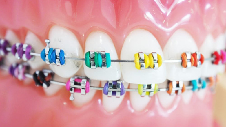 What is the Most Popular Color in Braces in 2022?
