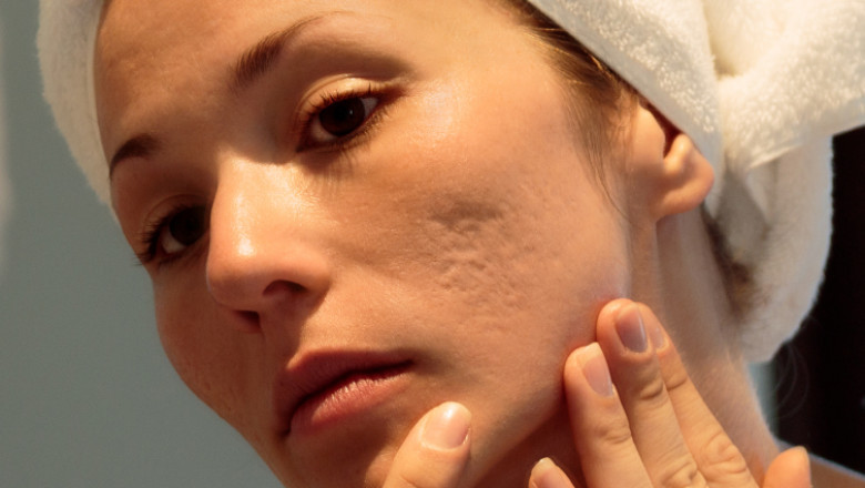 How Can I Remove Acne Scars Effectively?