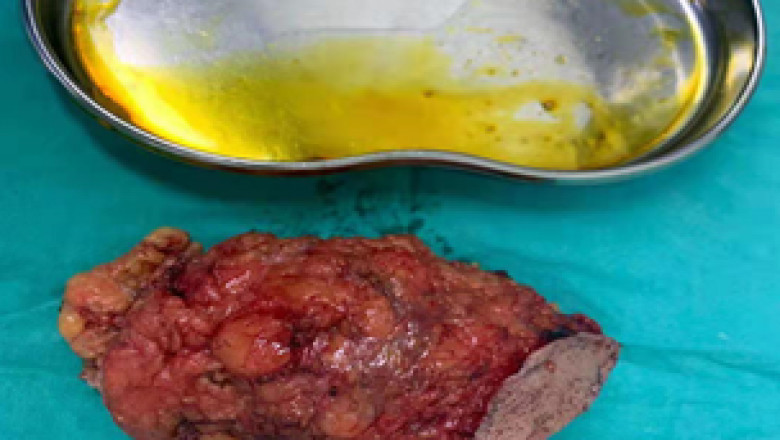 Clinics of Surgery | Surgery Journal | Open Access Journal