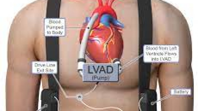 Left Ventricular Assist Device (LVAD) Market Current and Future Industry Analysis, Growth Research Prospects Report till 2026