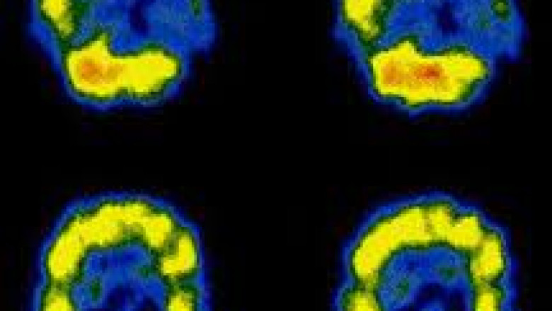 SPECT and SPECT-CT Market Growth Research 2021 by Global Industry Size, Demands, regions, Opportunity and Share Forecast to 2026