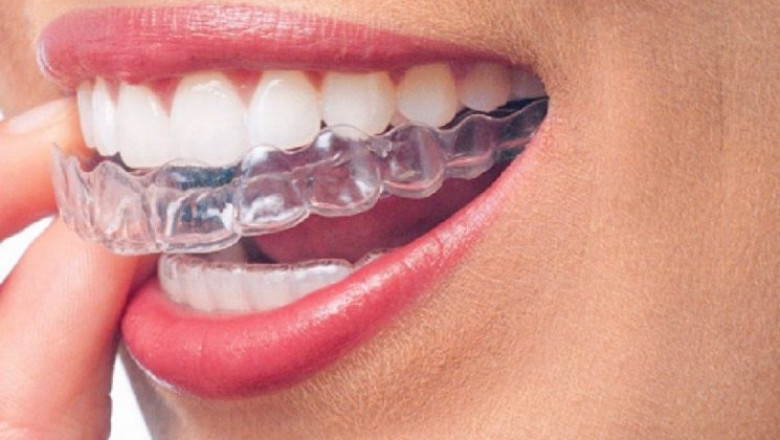 What Do You Mean By Temporary Fillings?