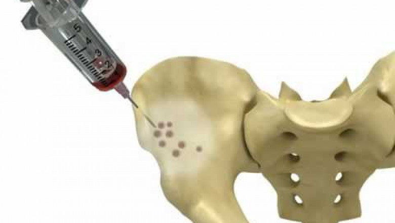 Bone Harvester Market Supply Demand Analysis and Growth Prospects Survey till 2026