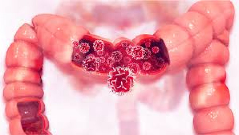 Capecitabine Market Growth Factors, Emerging Technologies, Prominent Players and Forecast Till 2026