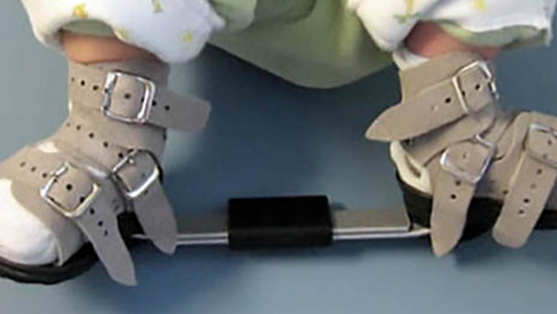 Clubfoot Surgeon in Delhi