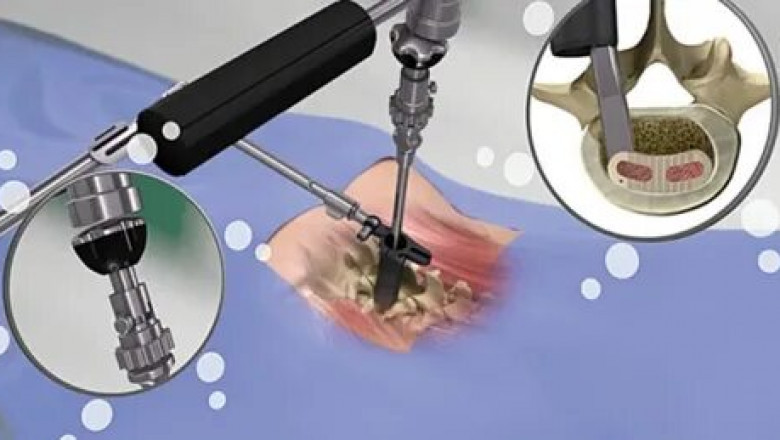 Demineralized Allografts Market Global Industry Updates, Business Prospects and Industry Share Forecast to 2026