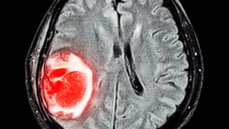 Who is the Best Neurosurgeon in NCR