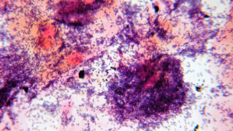 Bacterial Vaginosis Drug Market Treatment Analysis, Challenges to Current Therapies, Clinical manifestations and diagnosis 2021 to 2026