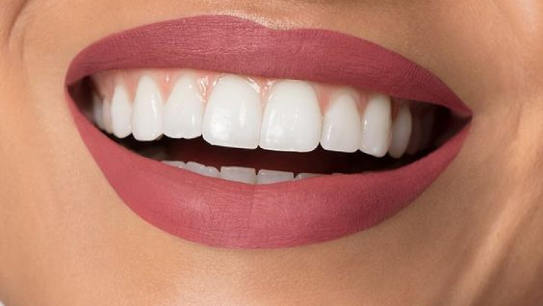 Different Methods Of Teeth Whitening