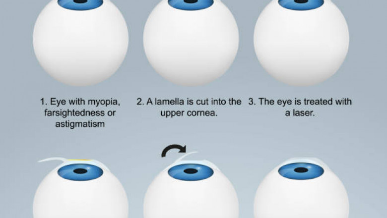 Does Lasik treatment affects your vision? Is it the best treatment option available?