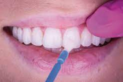 Fluoride Varnish Market Industry Analysis by Current Trends, Production, Sales and Consumption, Share and Global Growth Forecast to 2026