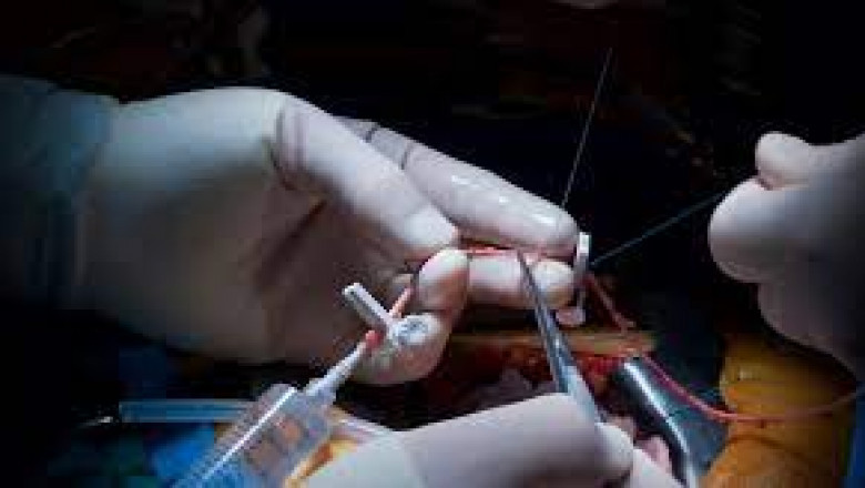 Vascular Grafts Market Report- Growth, Trends and Forecast to 2026 | Humacyte Inc, Eqalix Inc
