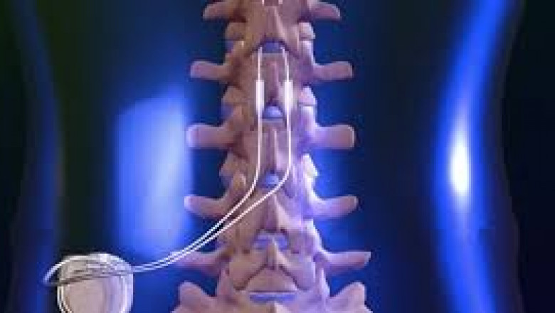 Spinal Cord Stimulation Devices Market Treatment Analysis, Global Trends in Clinical Study and Industry Forecast to 2026