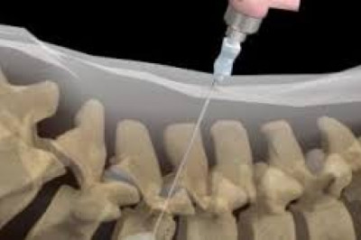 Vertebroplasty and Kyphoplasty Devices Market Surgical Technique and Clinical Outcomes, Comparative Analysis 2021 to 2026