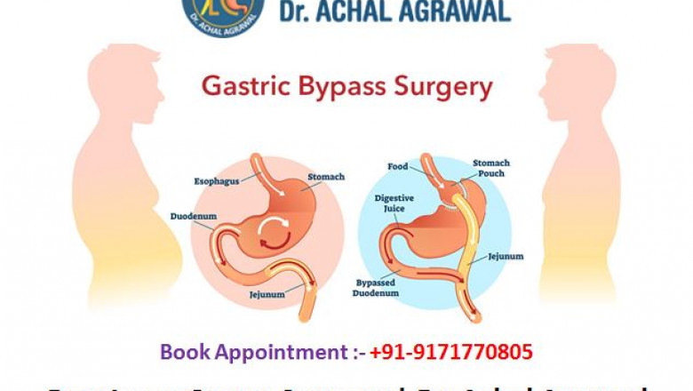 Best Laser Gastro Surgeon | Dr. Achal Agarwal | Indore-Laparoscopy-Center