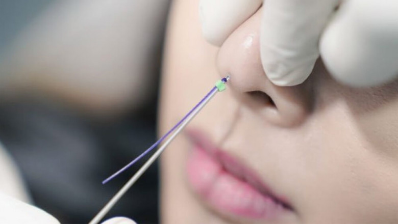 Cynosure laser vancouver