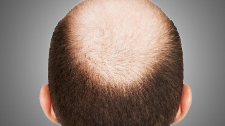 Alopecia Treatment Market Industry Trends, Growth, Size, Report Analysis, Share and Forecast 2021-2026