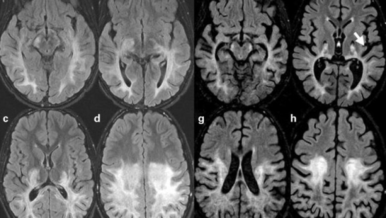 Cerebral Adrenoleukodystrophy Treatment Market Rising Trends, Industry Analysis and Demands 2022 to 2028