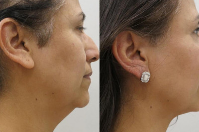 What Are Face Lifting Surgery And Its Advantages?