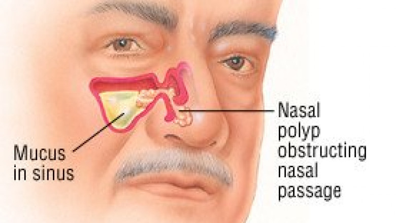 Global Nasal Polyps Treatment Market Report 2021: A $4,243.9 Million Market by 2030