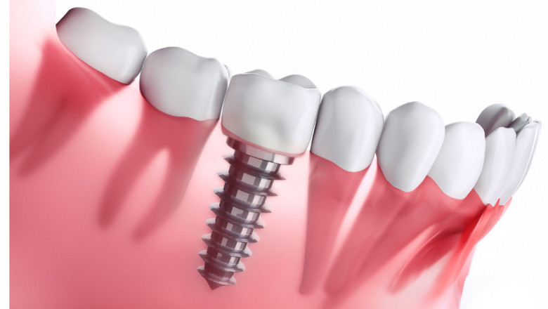 Dental Implant treatment in Kolkata