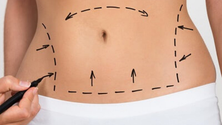 What can be expected after liposuction?