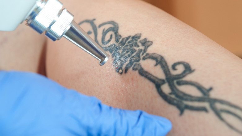 Tattoo Removal Market: Key Players, Growth, Analysis, 2021 - 2027