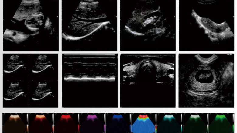 Global Black and White B-Ultrasound Market - Consumer & Market Insight: Da Wei,Sono Star,Mindray | IMR Market Reports