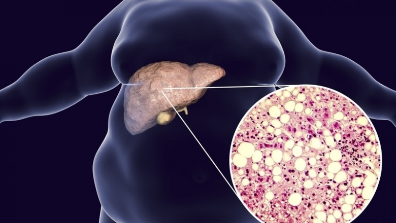 Hoe bestrijd je effectief ‘fatty liver disease’?