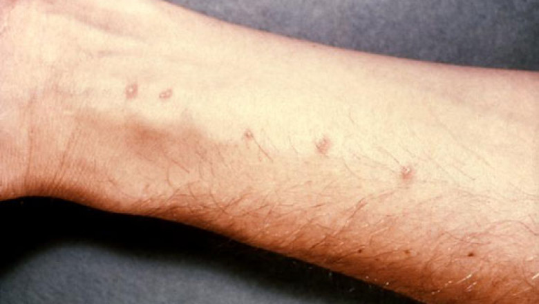 Schistosomiasis Disease Market 2022 Industry Outlook, Business Strategies and COVID-19 Impact Analysis 2029