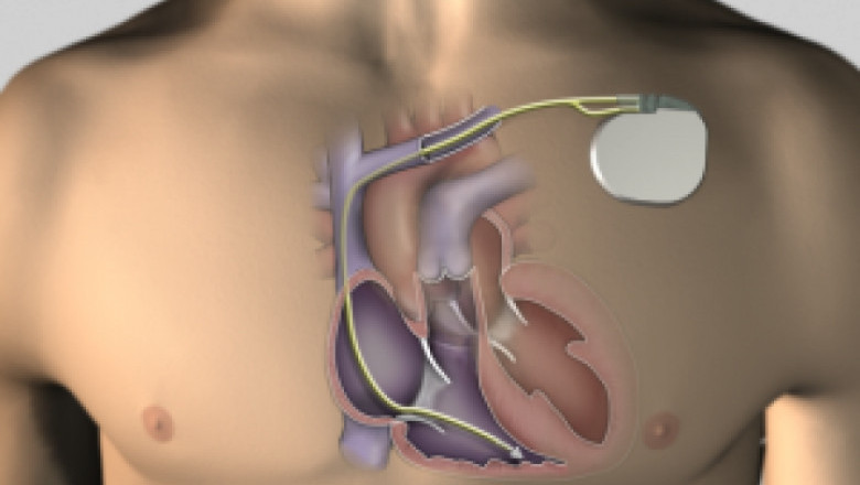 Pacemakers and Cardiac Resynchronization Therapy Devices Market Insights, Trends, Top Industry Players and Future Development Status by 2025 | Research Informatic