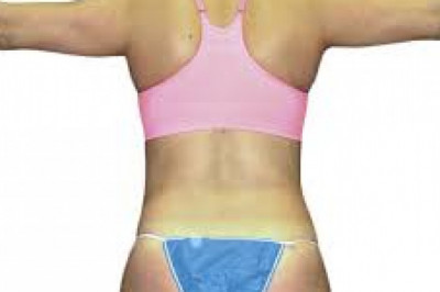 What Is All You Need To Know About Brazilian Butt Lift?