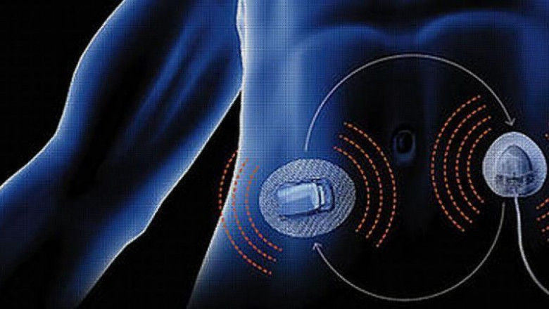 Artificial Pancreas Device System Market Key Trends
