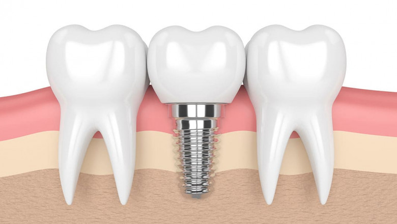 Sorts Of Oral Bridges: Pros and Cons