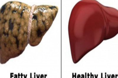 Fatty Liver: What is it and how to overcome it?