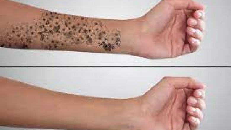 Best Laser Treatment for Tattoo Removal in Dubai