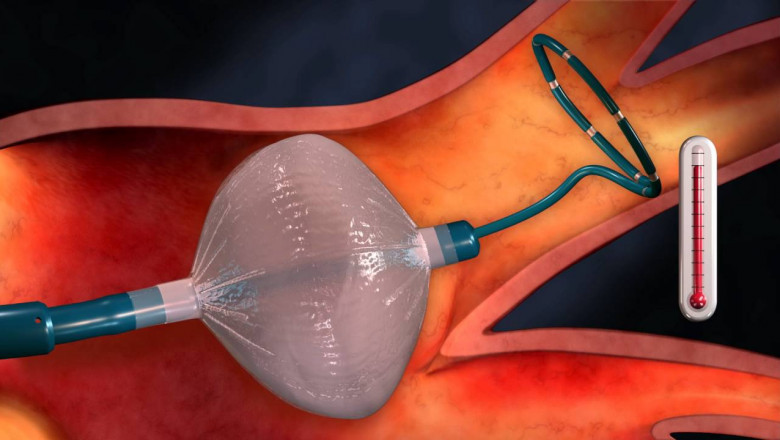 COVID-19 Impact on Cryoablation Device Market