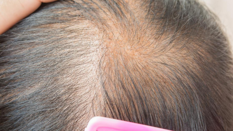 Hair Loss Treatment is a problem both for men and women