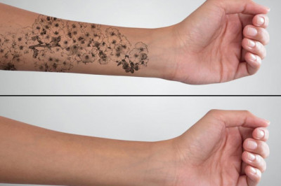 Tattoo Removal Market Report Available on Introspective Market Research 2022