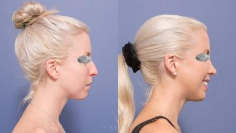 5 Reasons for Rhinoplasty