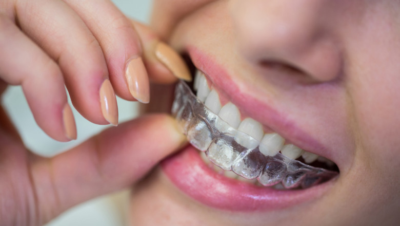 Metal Braces vs. Invisalign: Which is Best?