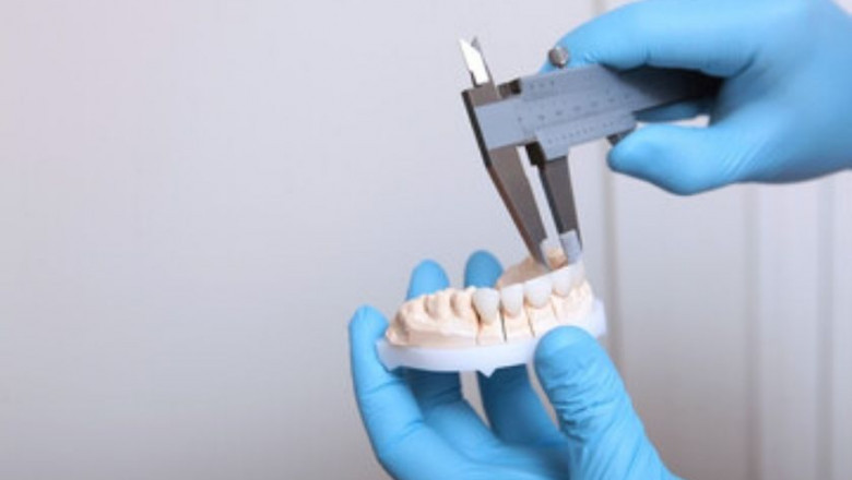 Benefits Of Dental Bonding Procedure