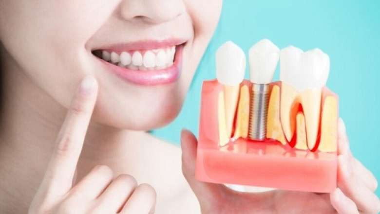 8 Benefits Of Dental Implants