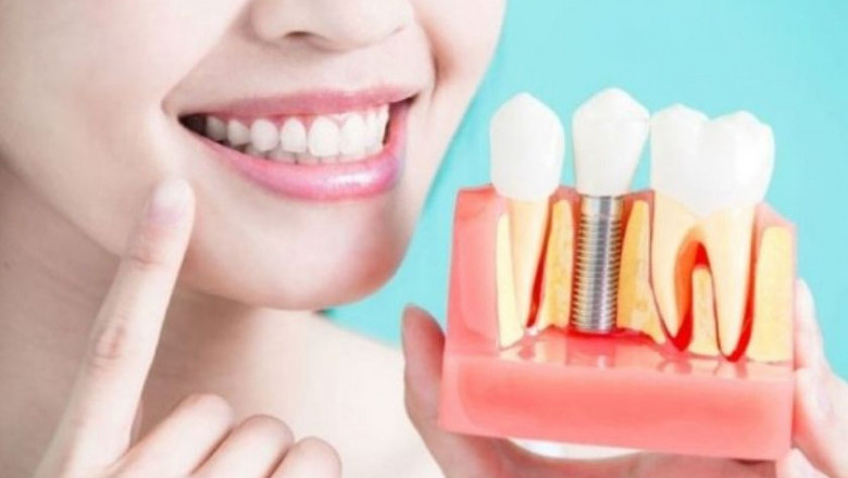 Is Dental Implant Right Choice For You?