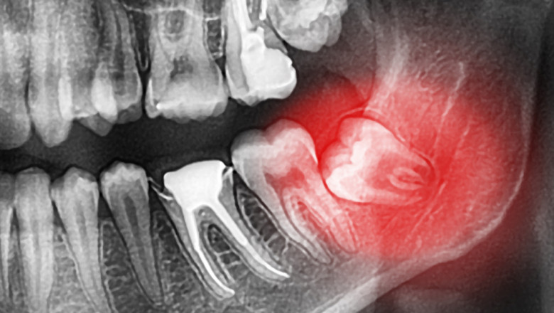 Oral Surgery Sedation